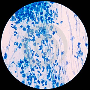 Blue leukocyte in Knee Joint