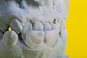 Blue plaster impression of the dental jaw of a patient with crooked teeth and malocclusions. Manufacturing of dentures