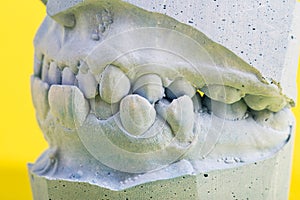 Blue plaster impression of the dental jaw of a patient with crooked teeth and malocclusions. Manufacturing of dentures