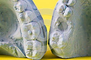 Blue plaster impression of a patient's dental jaw with crooked teeth and malocclusions on a yellow background