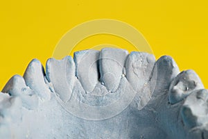 Blue plaster impression of a patient's dental jaw with crooked teeth and malocclusions on a yellow background
