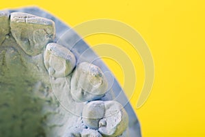 Blue plaster impression of a patient's dental jaw with crooked teeth and malocclusions on a yellow background