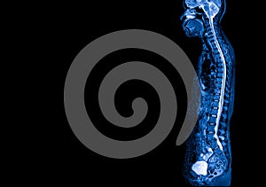 MRI of human spine in sagittal or lateral view.Diagnosis of spine metastasis with back pain.