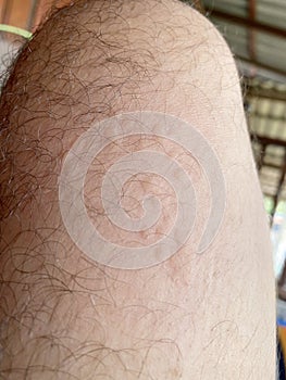 Blush of a tick-borne Lyme borreliosis disease on a man`s leg. Skin redness on the leg due to an allergy