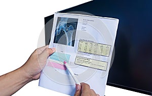 BMD DEXA densitometry hip scan. Osteopenia present, frequent precursor to osteoporosis on pen point on white background.Medical