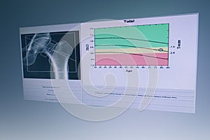 BMD Woman hip joint bone mass image The graph has a standard point below Therefore diagnosed with osteoporosis photo