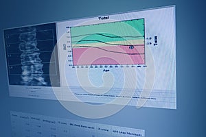 BMD Woman`s Lumbar spine bone mass image The graph has a standard point below Therefore diagnosed with osteoporosis photo