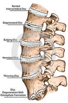 BOARD 1 Degenerative lumbar disc disease