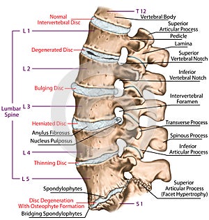 BOARD 2 Degenerative lumbar disc disease