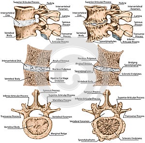 BOARD Advanced uncovertebral arthrosis