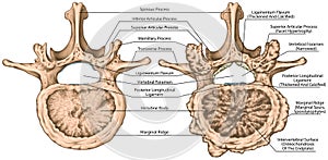 BOARD degenerative changes vertebra