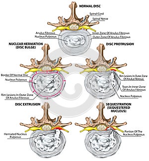 BOARD Nerves, stages of lumbar disc herniation