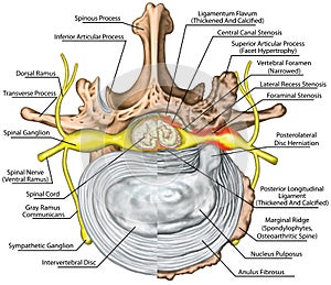 BOARD Stenosis, lumbar disk herniation VS good vertebra photo