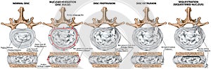 BOARD Types of lumbar disc herniation photo