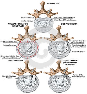 BOARD Types and stages of lumbar disc herniation