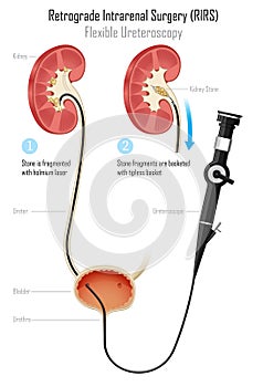 Retrograde Intrarenal Surgery, RIRS