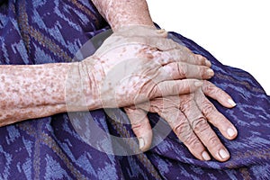 A body of elderly Asian women with of freckles and wrinkle
