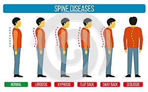 Body posture defect. Vector infographics of spine diseases. Scoliosis and lordosis medical diagrams