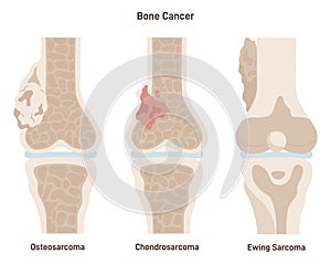 Bone cancer types set. Ewing's sarcoma, osteosarcoma and chondrosarcoma.