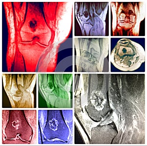 Bone chondroma knee pathology colorful collage