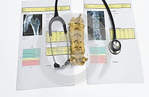 Bone density hip and lumbarspine Result Osteoporosis