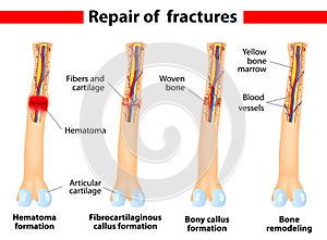 Bone fracture healing process