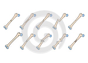 Bone fracture line icons set. Vector isolated element.