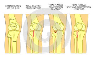 Bone fracture_Tibial plateau fracture