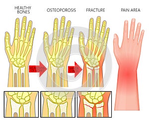 Bone fracture_Wrist fracture osteoporosis