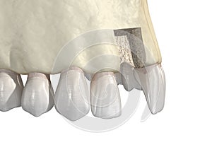 Bone grafting- augmentation using block of bone, tooth implantation. Medically accurate 3D illustration