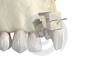 Bone grafting- augmentation using block of bone, tooth implantation. Medically accurate 3D illustration