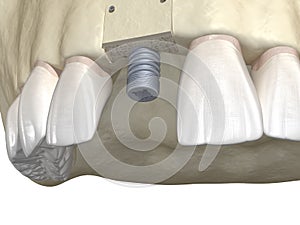 Bone grafting- augmentation using block of bone, tooth implantation. Medically accurate 3D illustration