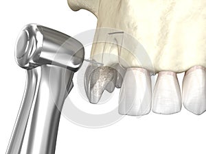 Bone grafting- augmentation using block of bone, tooth implantation. Medically accurate 3D illustration