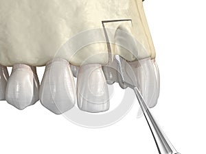 Bone grafting- augmentation using block of bone, tooth implantation. Medically accurate 3D illustration