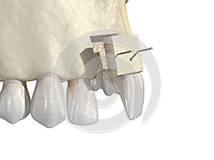 Bone grafting- augmentation using block of bone, tooth implantation. Medically accurate 3D illustration