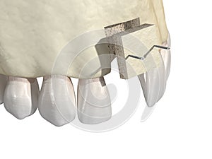 Bone grafting- augmentation using block of bone, tooth implantation. Medically accurate 3D illustration