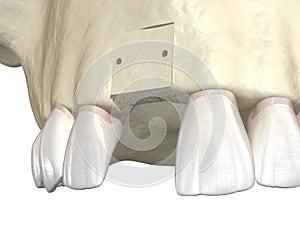 Bone grafting- augmentation using block of bone, tooth implantation. Medically accurate 3D illustration