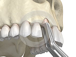 Bone grafting- augmentation using ring method, tooth implantation. Medically accurate 3D illustration