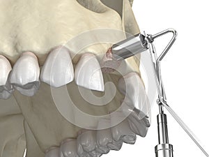 Bone grafting- augmentation using ring method, tooth implantation. Medically accurate 3D illustration