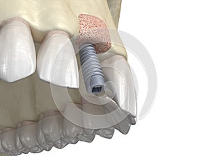 Bone grafting- augmentation using ring method, tooth implantation. Medically accurate 3D illustration