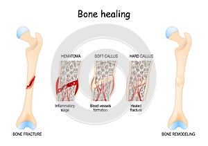 Bone healing Process after a bone fracture photo