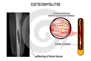 Bone lesions osteomyelitis