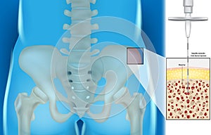 Bone Marrow Aspiration And Biopsy. Illustration of the Needle extends into bone marrow.