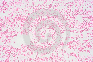 Bone marrow biopsy from myelodysplastic condition under the microscope view
