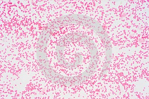 Bone marrow biopsy from myelodysplastic condition under the microscope view