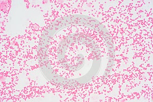 Bone marrow biopsy from myelodysplastic condition under the microscope view