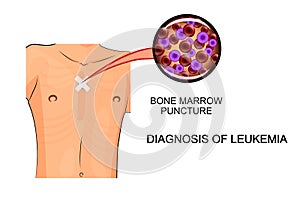 Bone marrow puncture leukemia photo