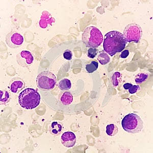 Bone marrow study : Dimorphic Erythroid hyperplasia