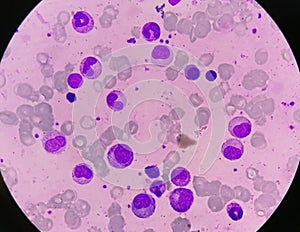 Bone marrow study: Dimorphic Erythroid hyperplasia