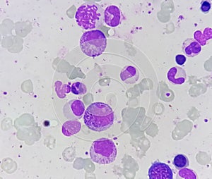 Bone marrow study: dimorphic Erythroid hyperplasia